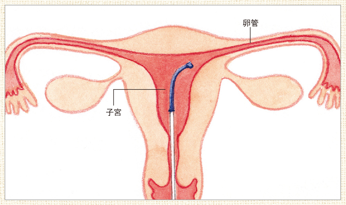 卵管鏡下卵管形成術の様子