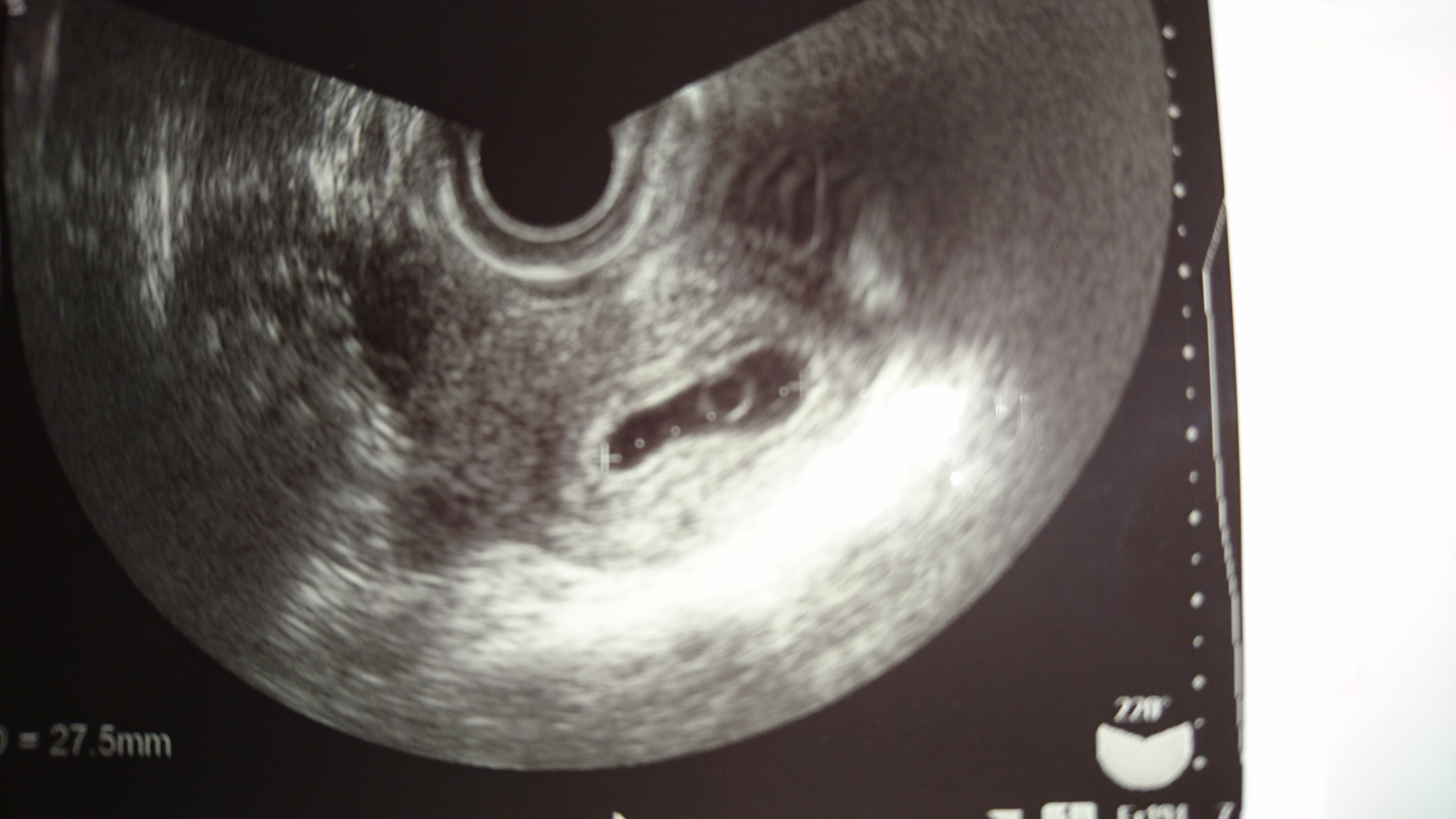 妊娠6週2日 胎嚢は大きいのに卵黄嚢しか見えない 女性の健康 ジネコ